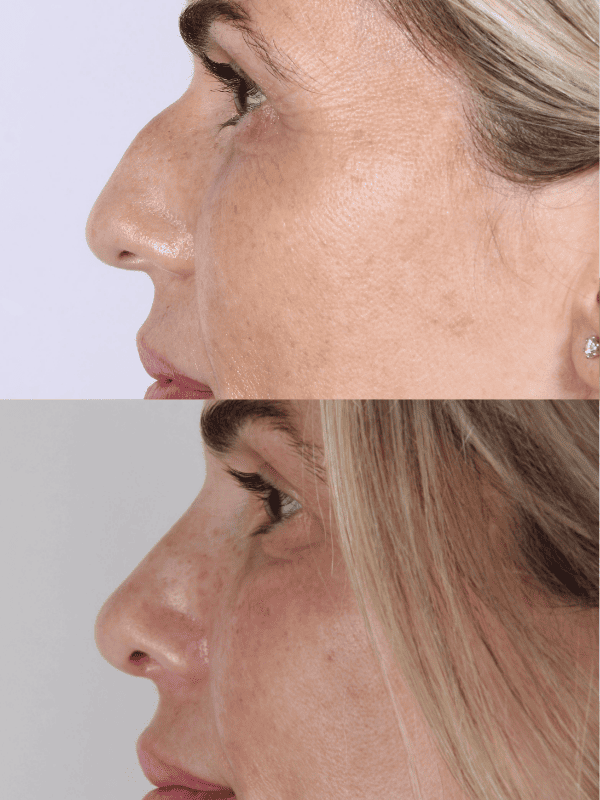 Rinoplastia Ultrasónica