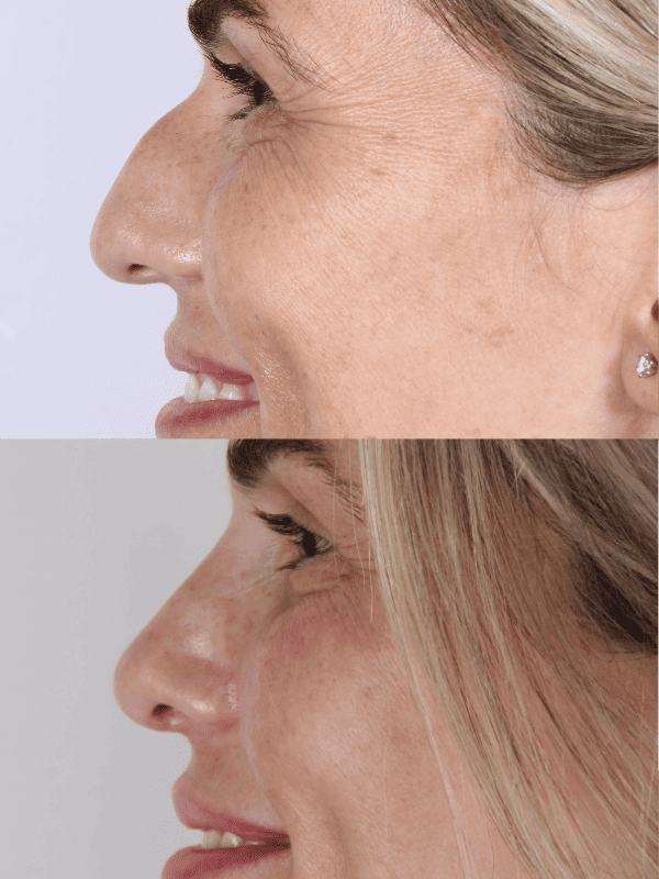 Rinoplastia Ultrasónica