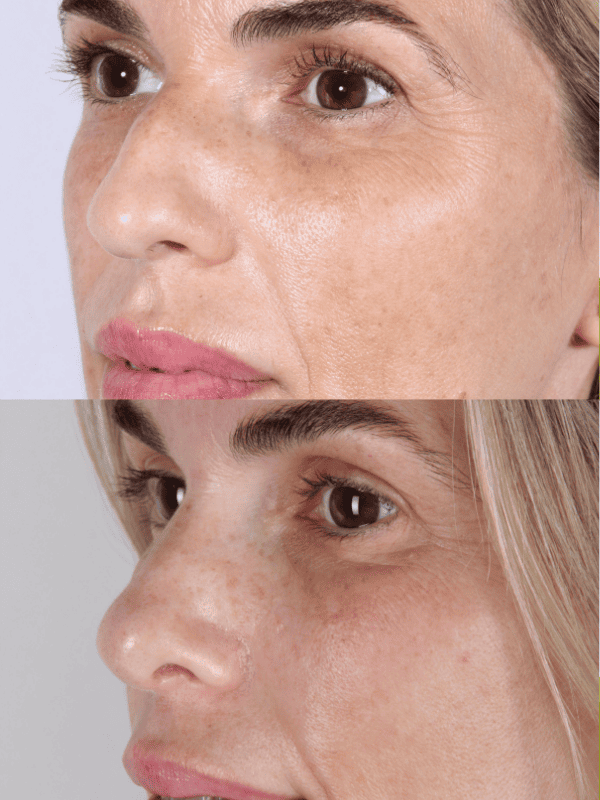 Rinoplastia Ultrasónica