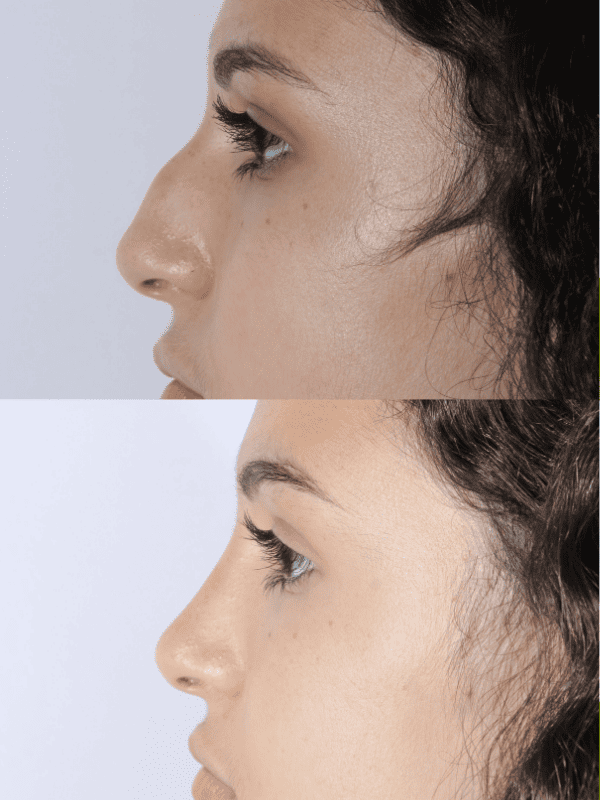 Rinoplastia Ultrasónica