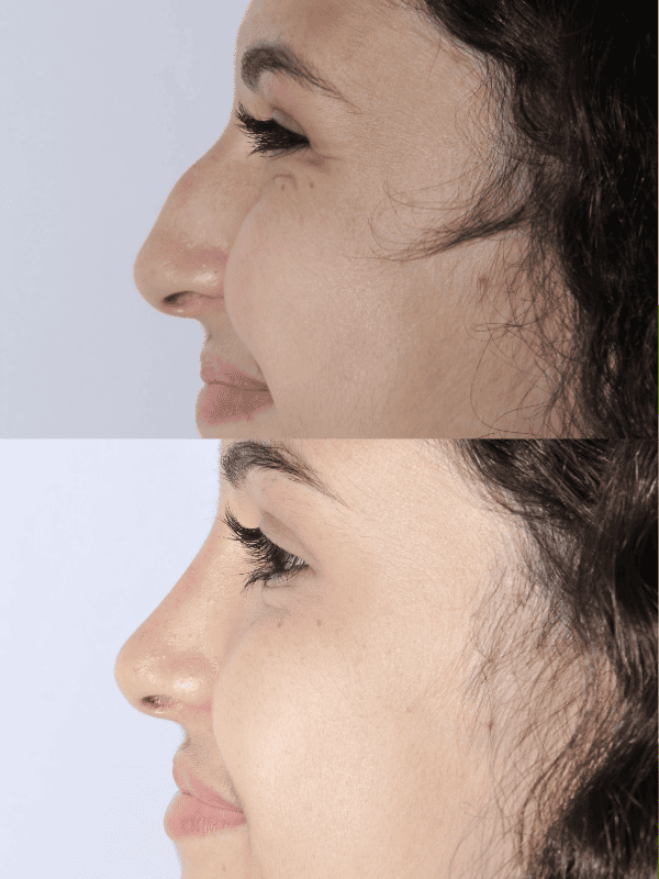 Rinoplastia Ultrasónica