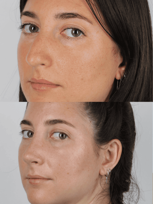 Rinoplastia Ultrasónica