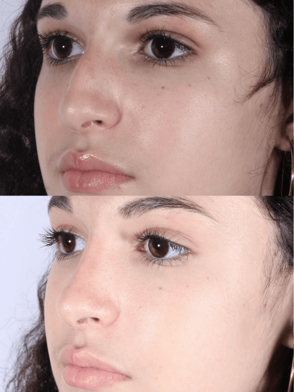 Rinoplastia Ultrasónica