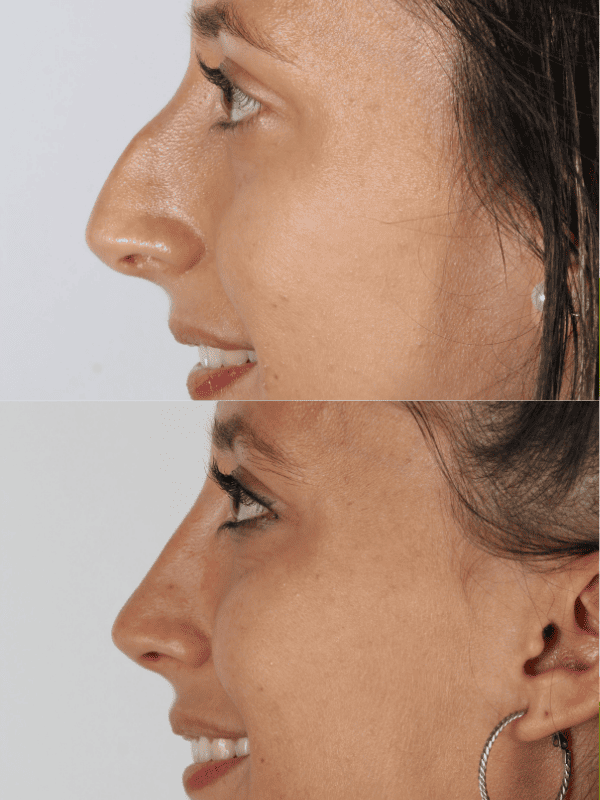 Rinoplastia Ultrasónica