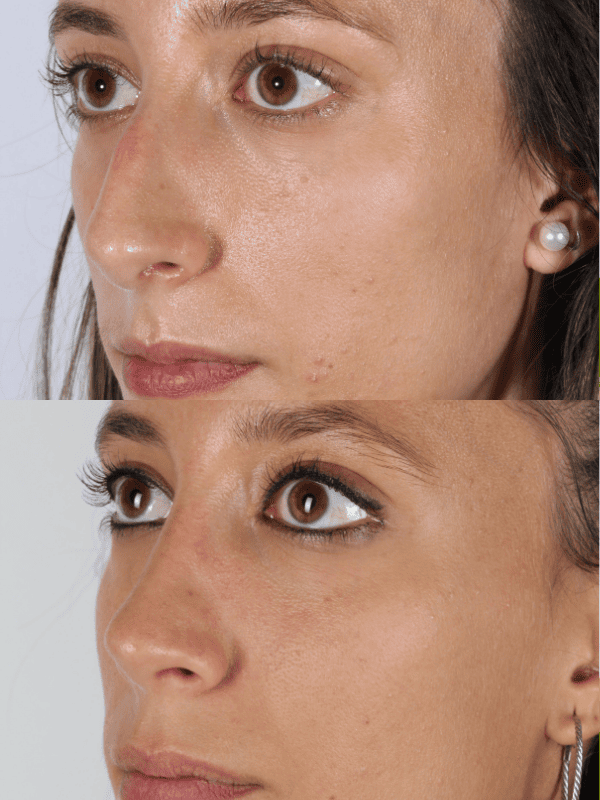 Rinoplastia Ultrasónica