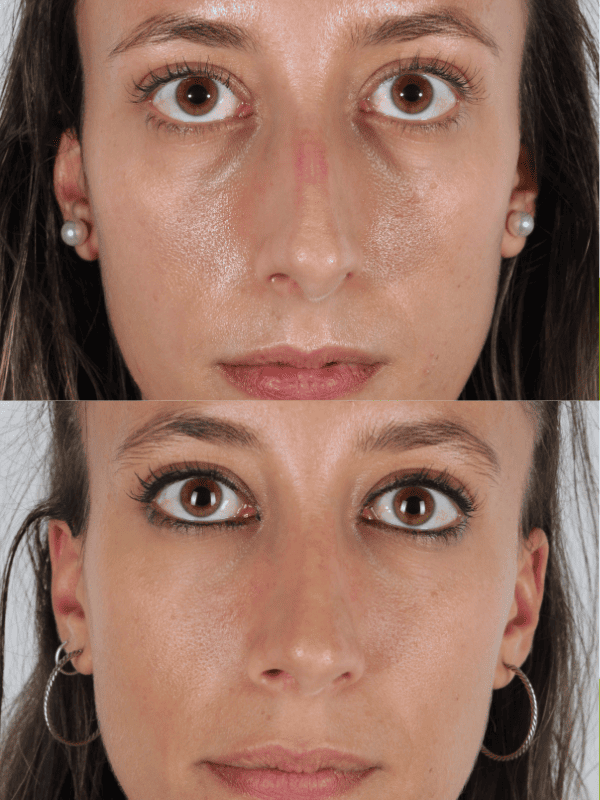 Rinoplastia Ultrasónica