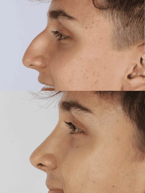Rinoplastia Ultrasónica