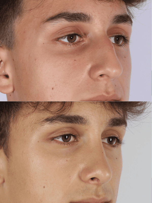 Rinoplastia Ultrasónica