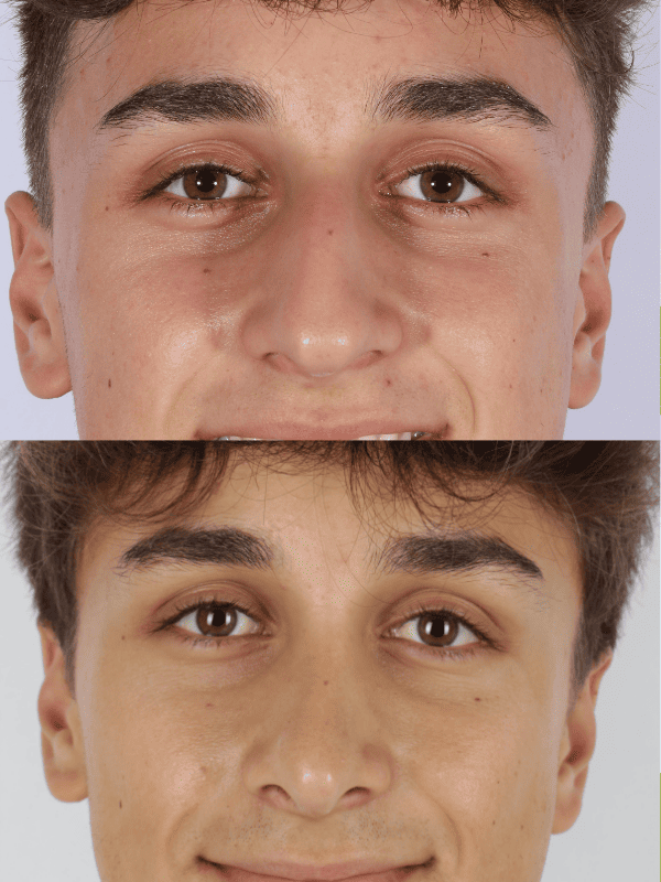 Rinoplastia Ultrasónica