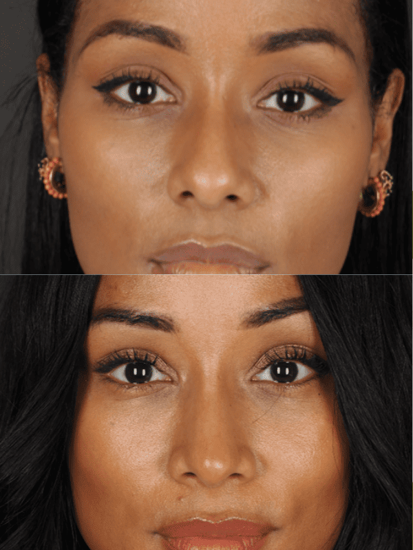 Rinoplastia Ultrasónica