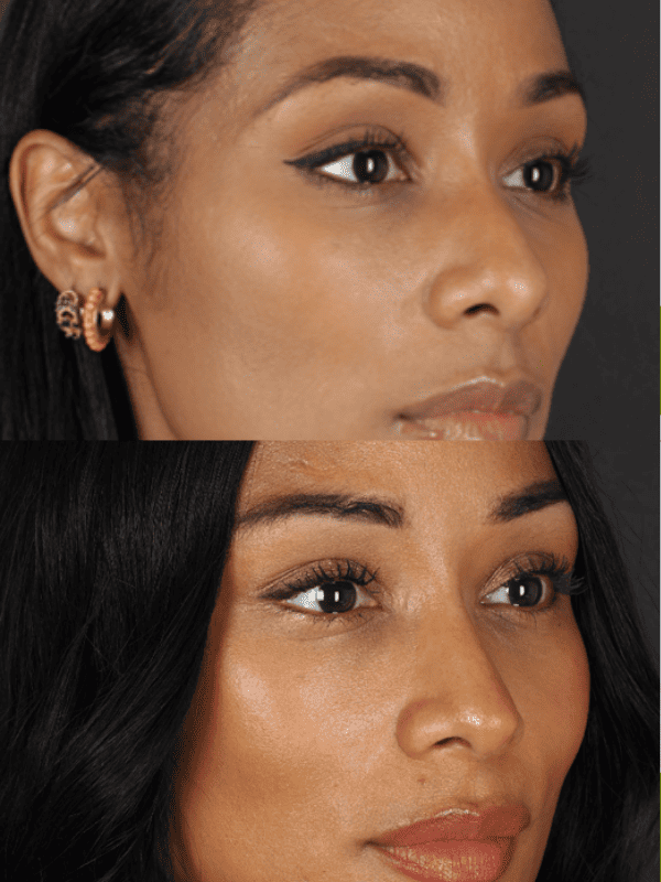 Rinoplastia Ultrasónica