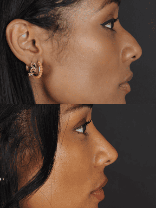 Rinoplastia Ultrasónica