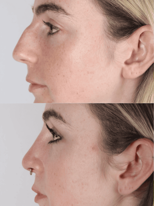 Rinoplastia Ultrasónica